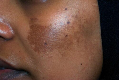 Treating The Face of Melasma