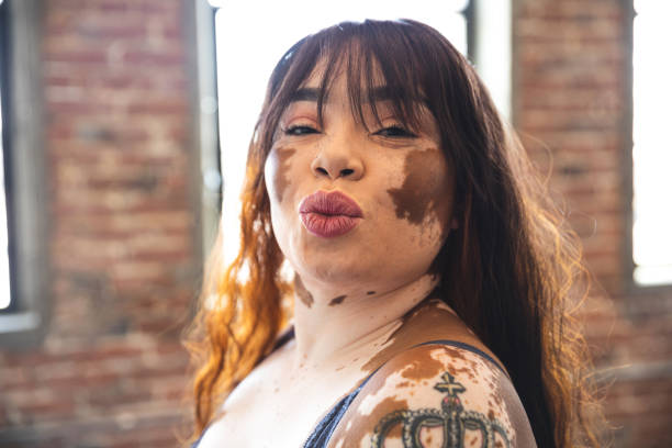 Vitiligo Condition – Keeping Your Chin Up