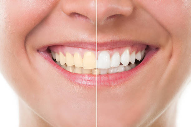 Easy Homemade Ways To Whiten Teeth